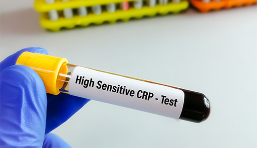 High-Sensitivity C-Reactive Protein Test (hs-CRP)
