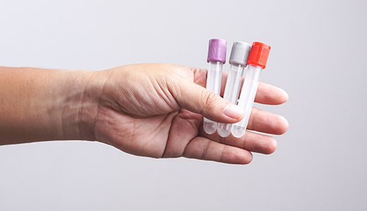 Epstein-Barr Virus Viral Capsid Antigen Test (IgM)