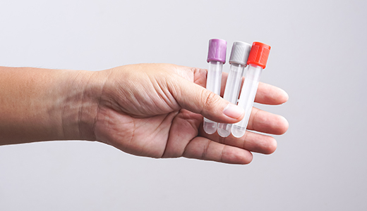 Herpes Simplex Virus 1 and 2 (IgG), Type-Specific Antibodies - Jupiter